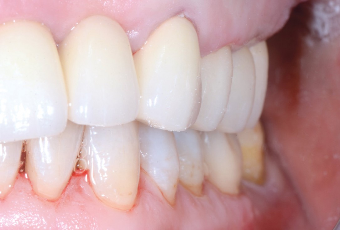 Immediate implant placement in the mandibular with collacone® max – Dr. D. Jelušić