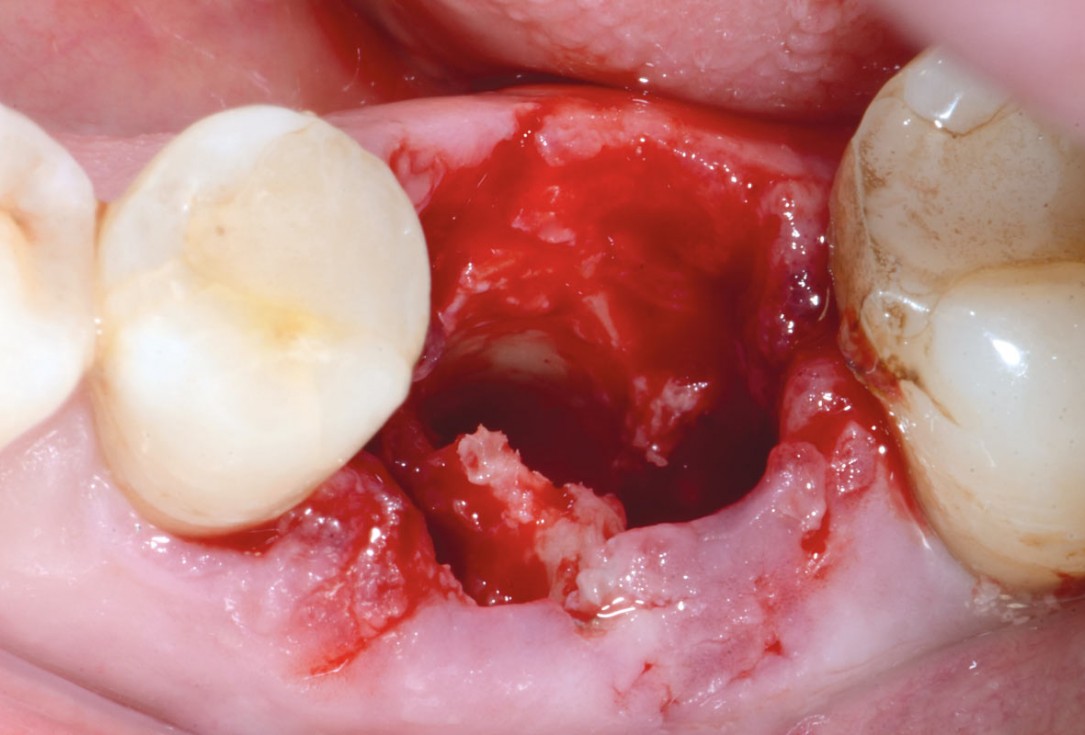 Immediate implant placement in the mandibular with collacone® max – Dr. D. Jelušić
