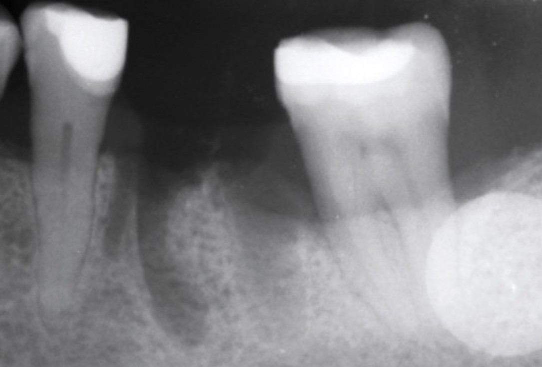 Immediate implant placement in the mandibular with collacone® max – Dr. D. Jelušić