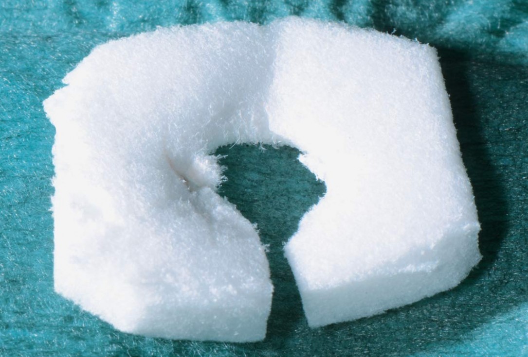 Immediate implant placement in the mandibular with collacone® max – Dr. D. Jelušić