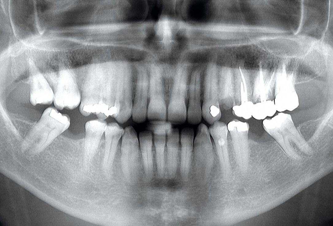 Multiple socket preservation in the maxilla with collacone® max – Dr. D. Jelušić