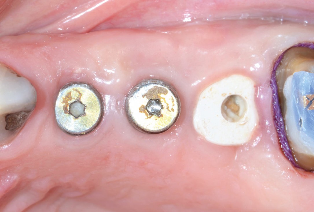 Multiple socket preservation in the maxilla with collacone® max – Dr. D. Jelušić
