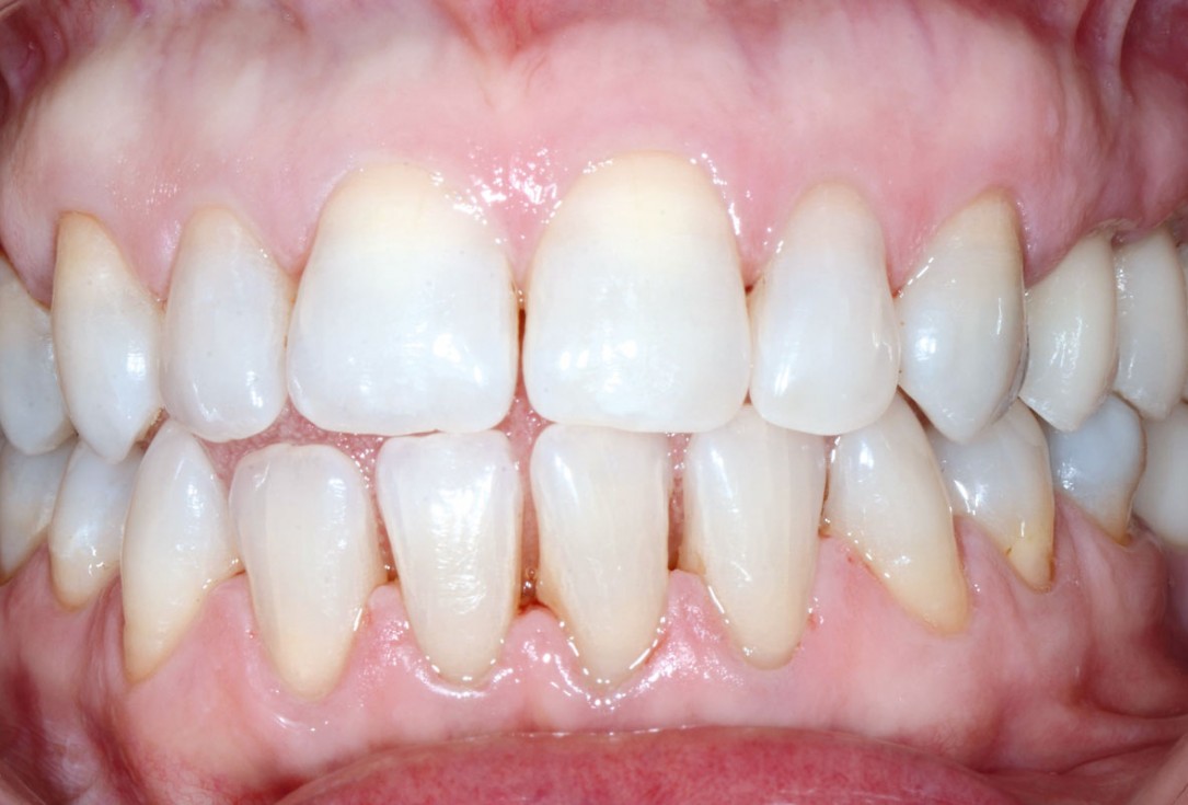 Multiple socket preservation in the maxilla with collacone® max – Dr. D. Jelušić