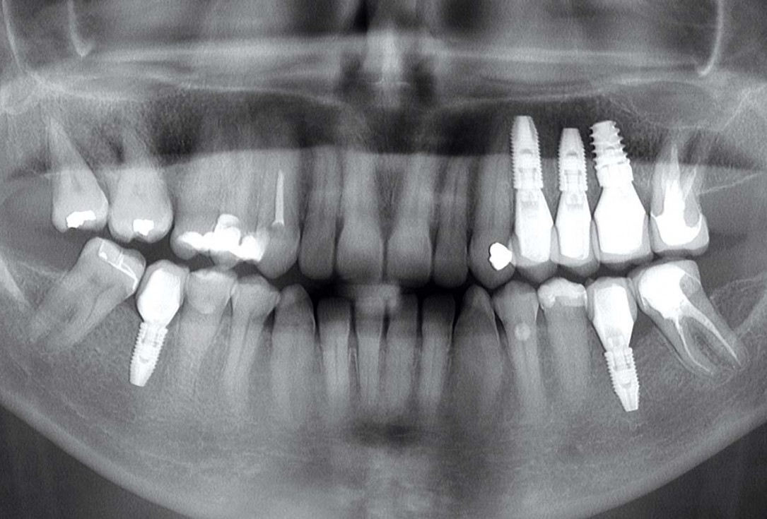 Multiple socket preservation in the maxilla with collacone® max – Dr. D. Jelušić