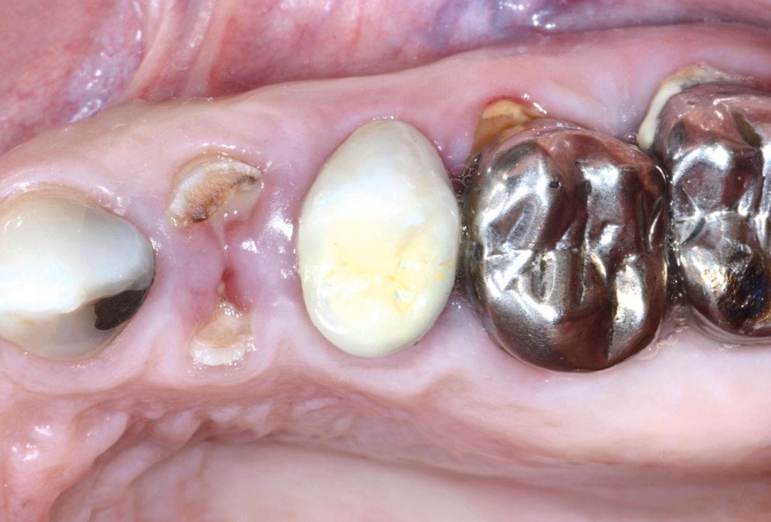 Multiple socket preservation in the maxilla with collacone® max – Dr. D. Jelušić