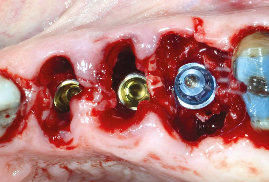 Multiple socket preservation in the maxilla with collacone® max – Dr. D. Jelušić