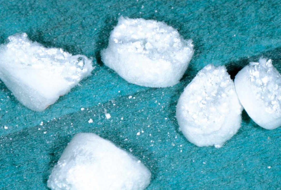 Multiple socket preservation in the maxilla with collacone® max – Dr. D. Jelušić