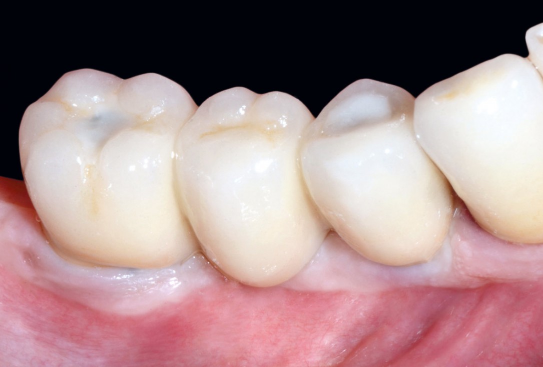 Multiple socket preservation in the mandibular with collacone® max – Dr. D. Jelušić