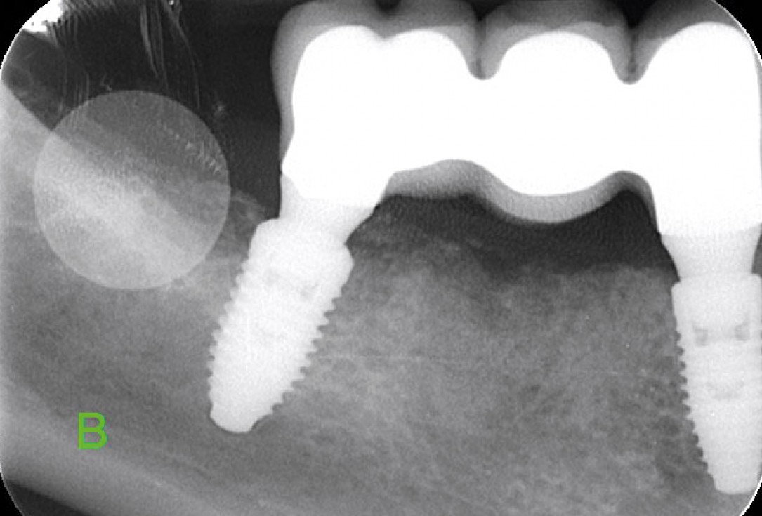 Multiple socket preservation in the mandibular with collacone® max – Dr. D. Jelušić