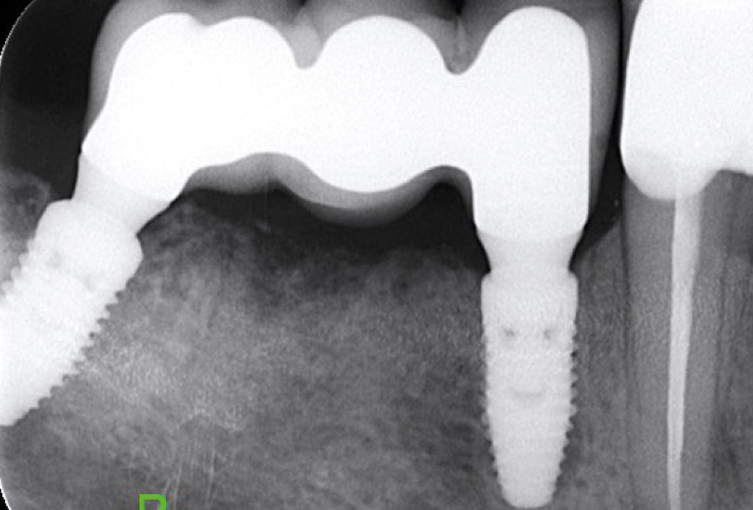 Multiple socket preservation in the mandibular with collacone® max – Dr. D. Jelušić