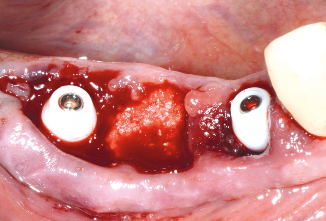 Multiple socket preservation in the mandibular with collacone® max – Dr. D. Jelušić