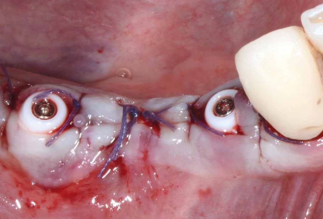 Multiple socket preservation in the mandibular with collacone® max – Dr. D. Jelušić