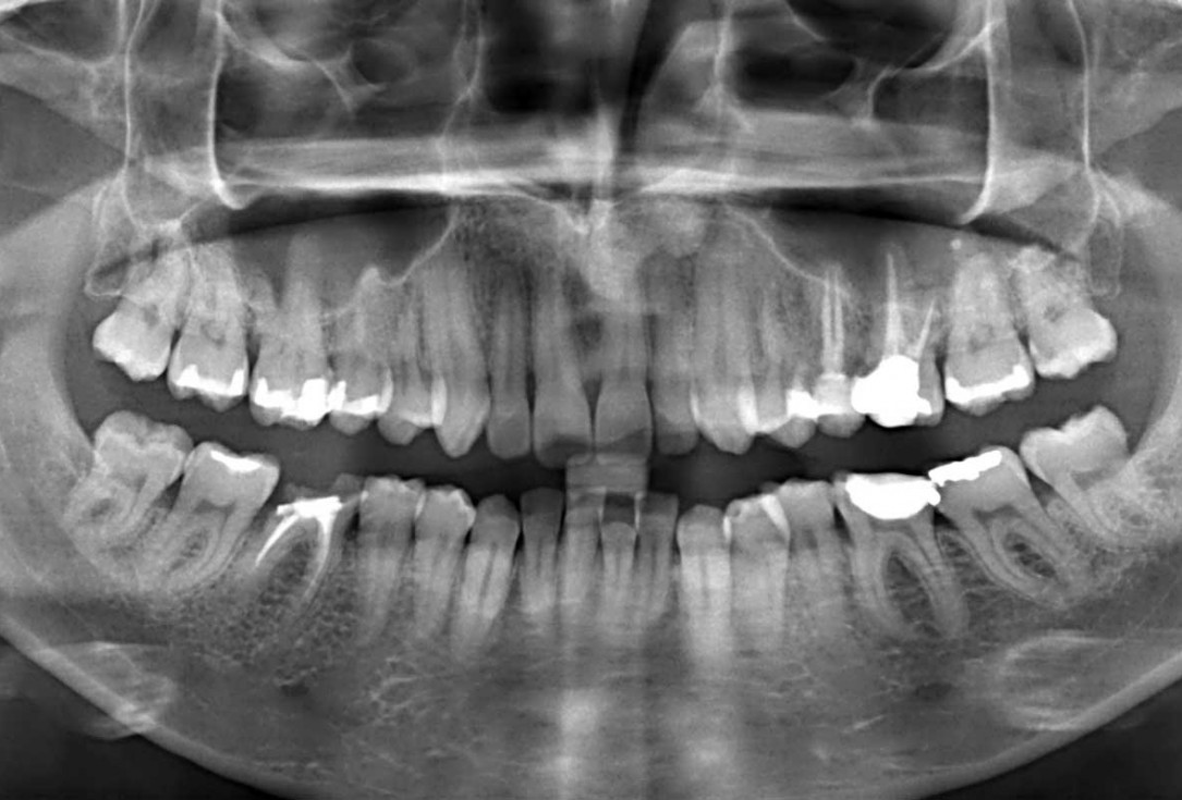 botiss cerabone plus for immediate implant placement and peri-implant bone augmentation - clinical case by Dr. R. Block Veras