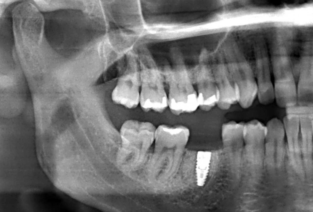 botiss cerabone plus for immediate implant placement and peri-implant bone augmentation - clinical case by Dr. R. Block Veras