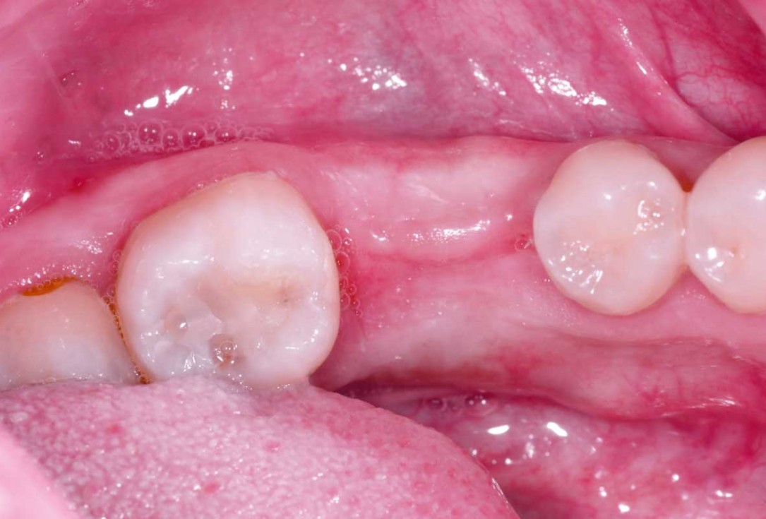 botiss cerabone plus for immediate implant placement and peri-implant bone augmentation - clinical case by Dr. R. Block Veras