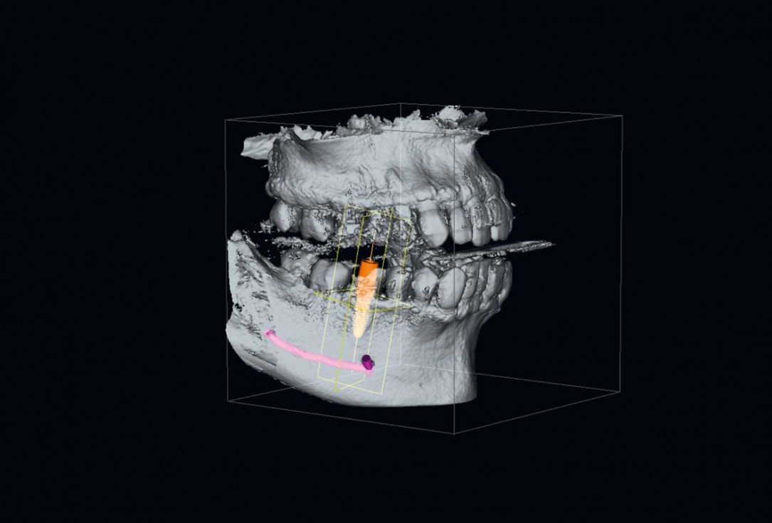 botiss cerabone plus for immediate implant placement and peri-implant bone augmentation - clinical case by Dr. R. Block Veras