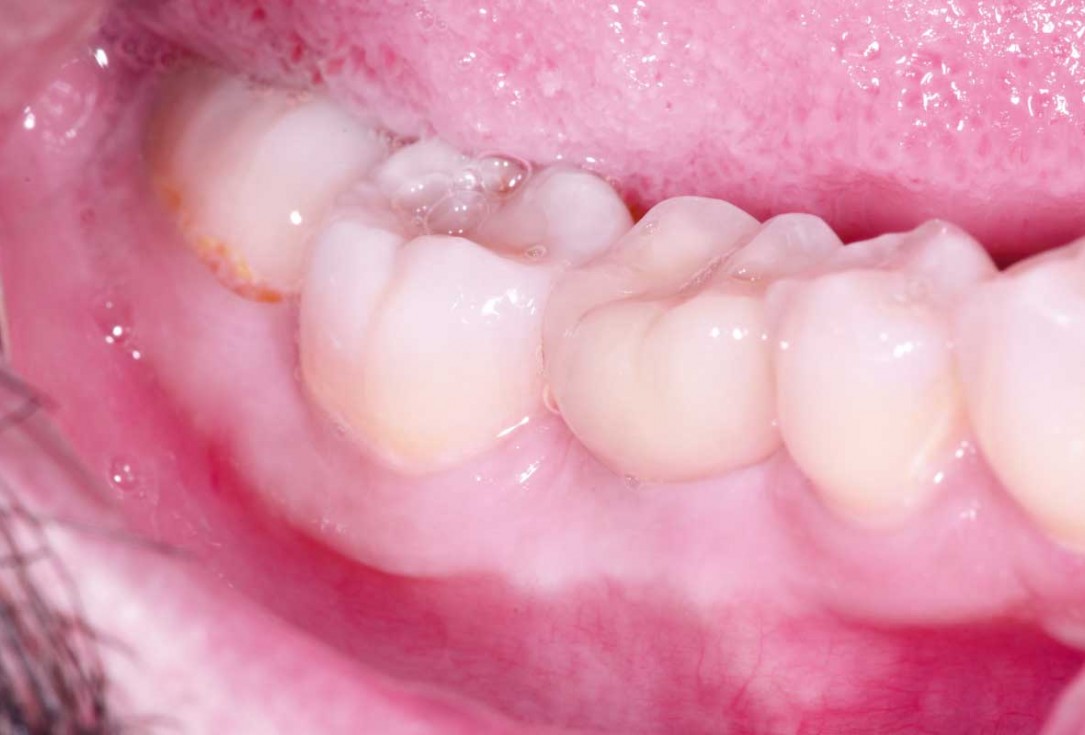 botiss cerabone plus for immediate implant placement and peri-implant bone augmentation - clinical case by Dr. R. Block Veras