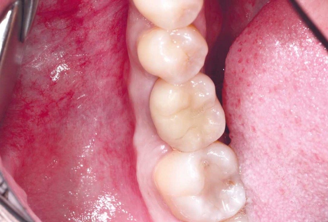 botiss cerabone plus for immediate implant placement and peri-implant bone augmentation - clinical case by Dr. R. Block Veras