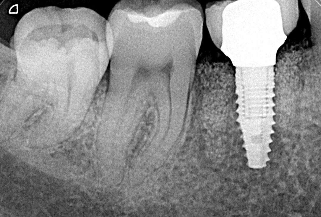 botiss cerabone plus for immediate implant placement and peri-implant bone augmentation - clinical case by Dr. R. Block Veras
