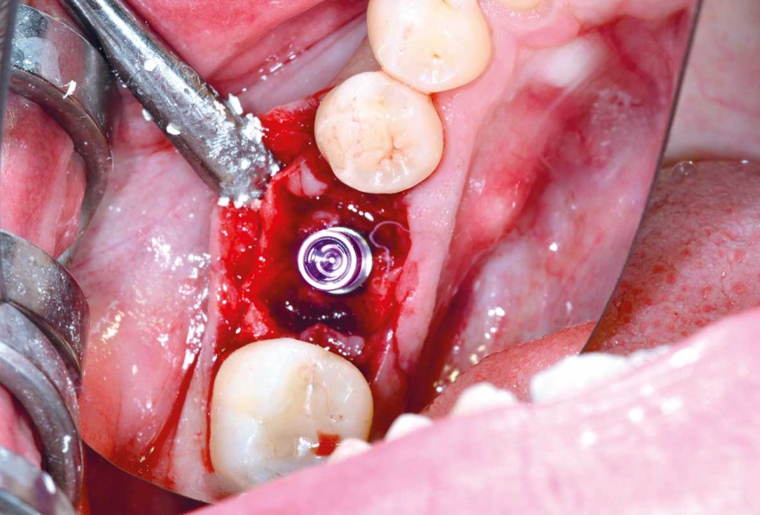 botiss cerabone plus for immediate implant placement and peri-implant bone augmentation - clinical case by Dr. R. Block Veras