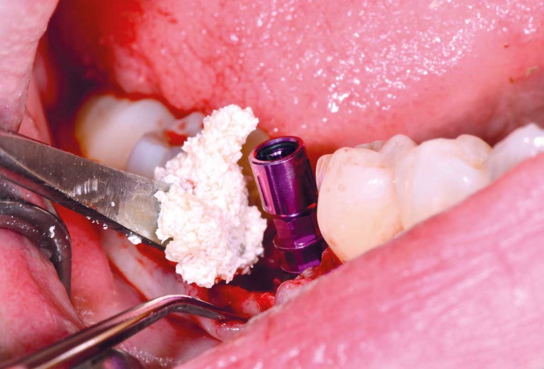 botiss cerabone plus for immediate implant placement and peri-implant bone augmentation - clinical case by Dr. R. Block Veras