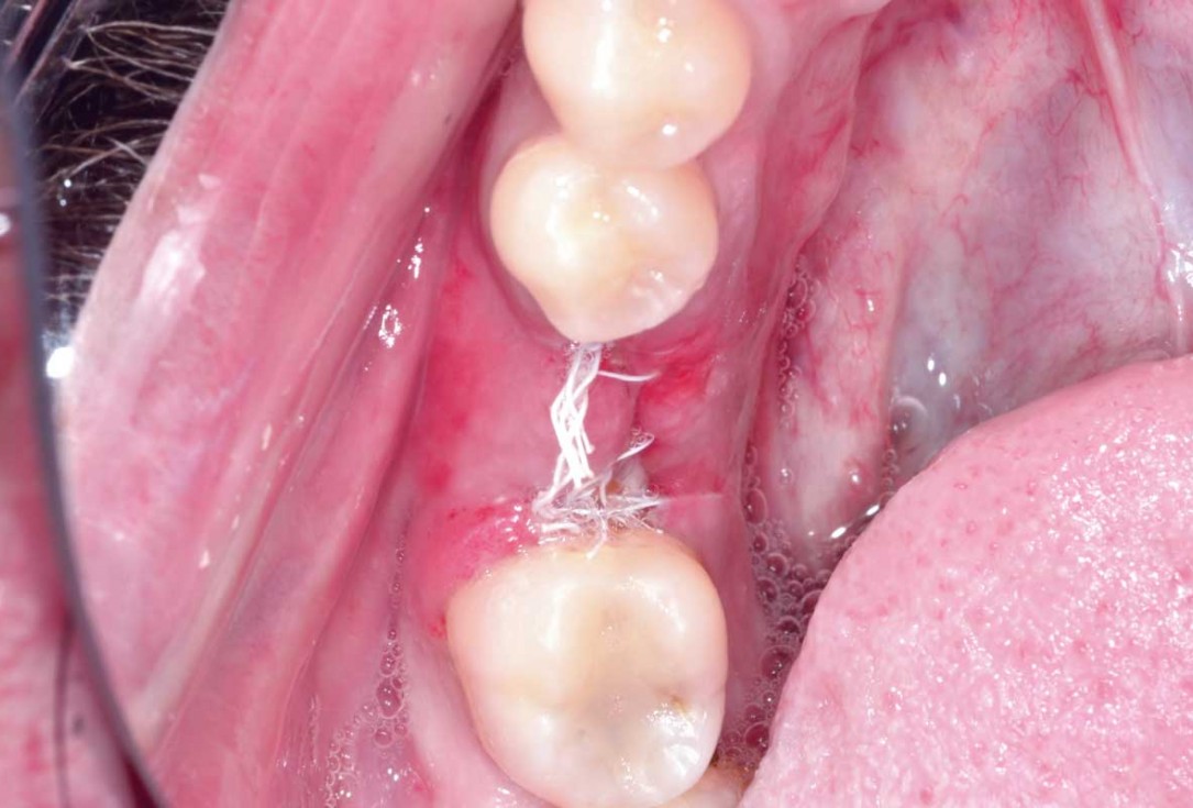 botiss cerabone plus for immediate implant placement and peri-implant bone augmentation - clinical case by Dr. R. Block Veras
