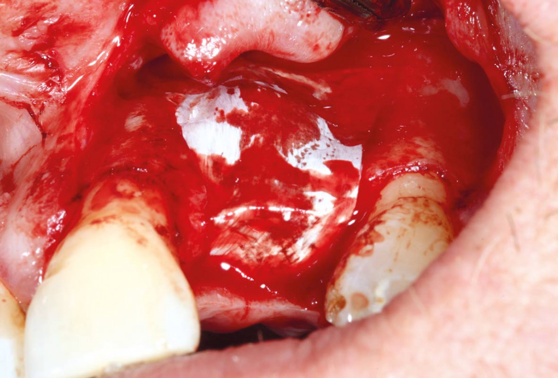 Restoration of single tooth gap in aesthetic zone with maxgraft® bonering - Dr. R. Cutts