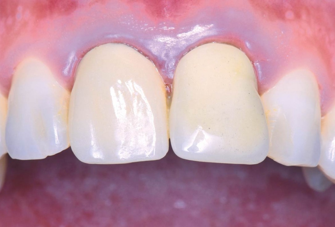 cerabone® and mucoderm® for immediate implantation in the aesthetic area - Dr. D. Robles 