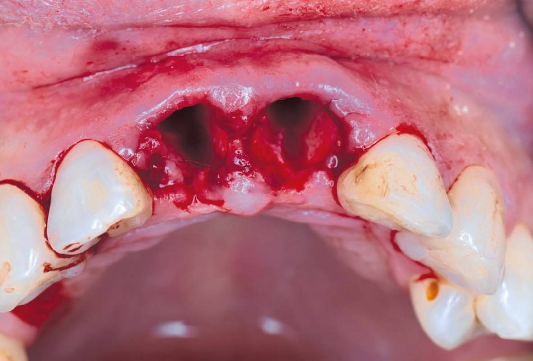 cerabone® and mucoderm® for immediate implantation in the aesthetic area - Dr. D. Robles 