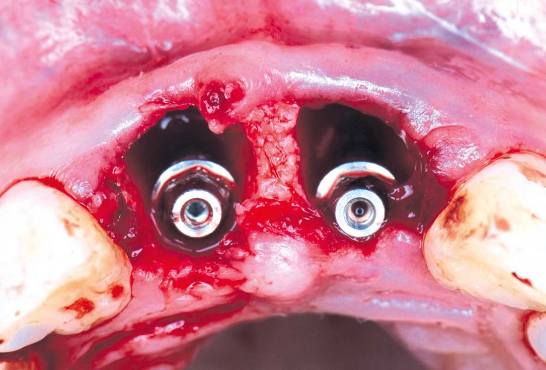 cerabone® and mucoderm® for immediate implantation in the aesthetic area - Dr. D. Robles 