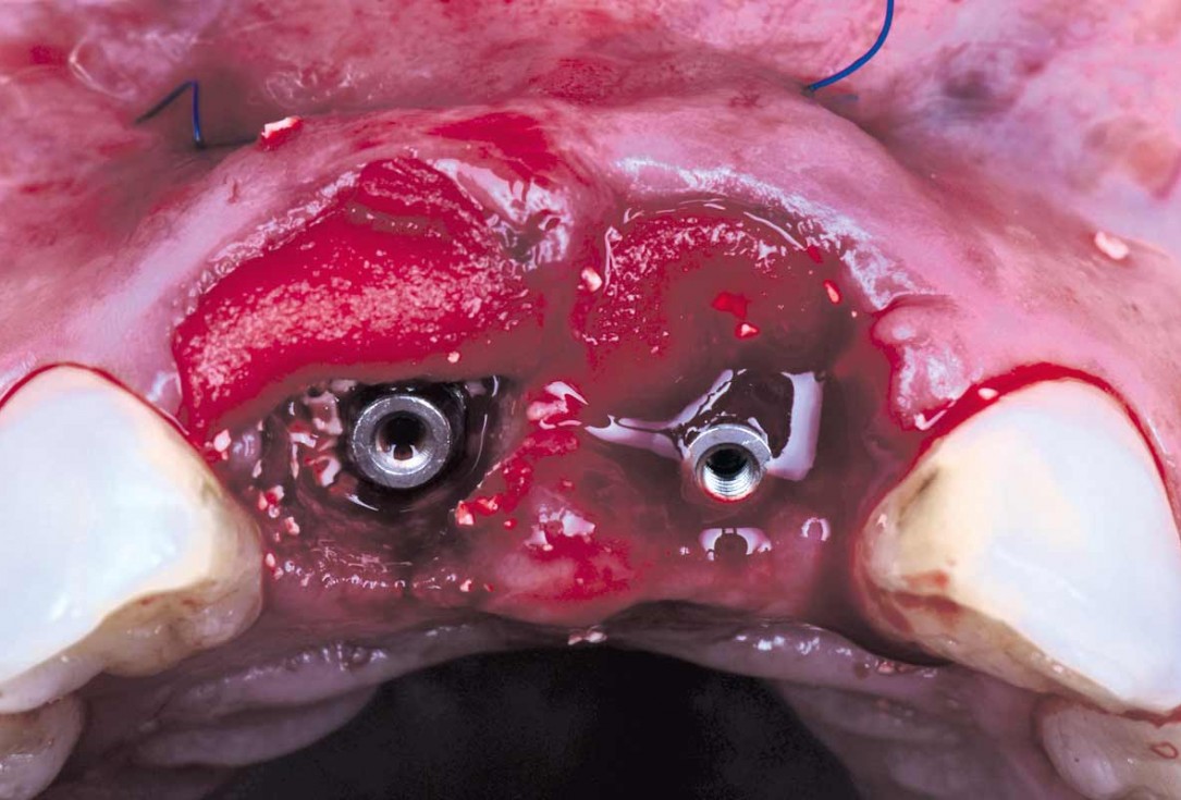 cerabone® and mucoderm® for immediate implantation in the aesthetic area - Dr. D. Robles 