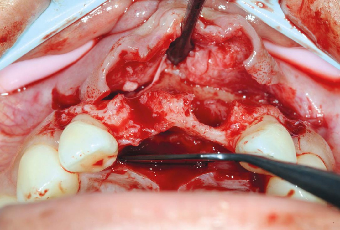 Bone augmentation in aesthetic zone with maxgraft® bonering - Dr. A. Patel