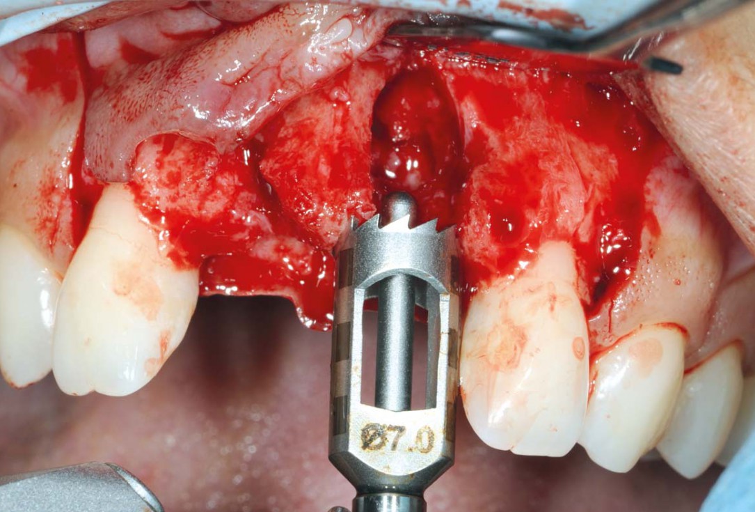 Bone augmentation in aesthetic zone with maxgraft® bonering - Dr. A. Patel