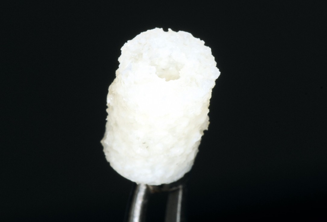 Bone augmentation in aesthetic zone with maxgraft® bonering - Dr. A. Patel