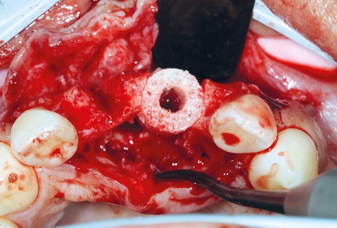 Bone augmentation in aesthetic zone with maxgraft® bonering - Dr. A. Patel