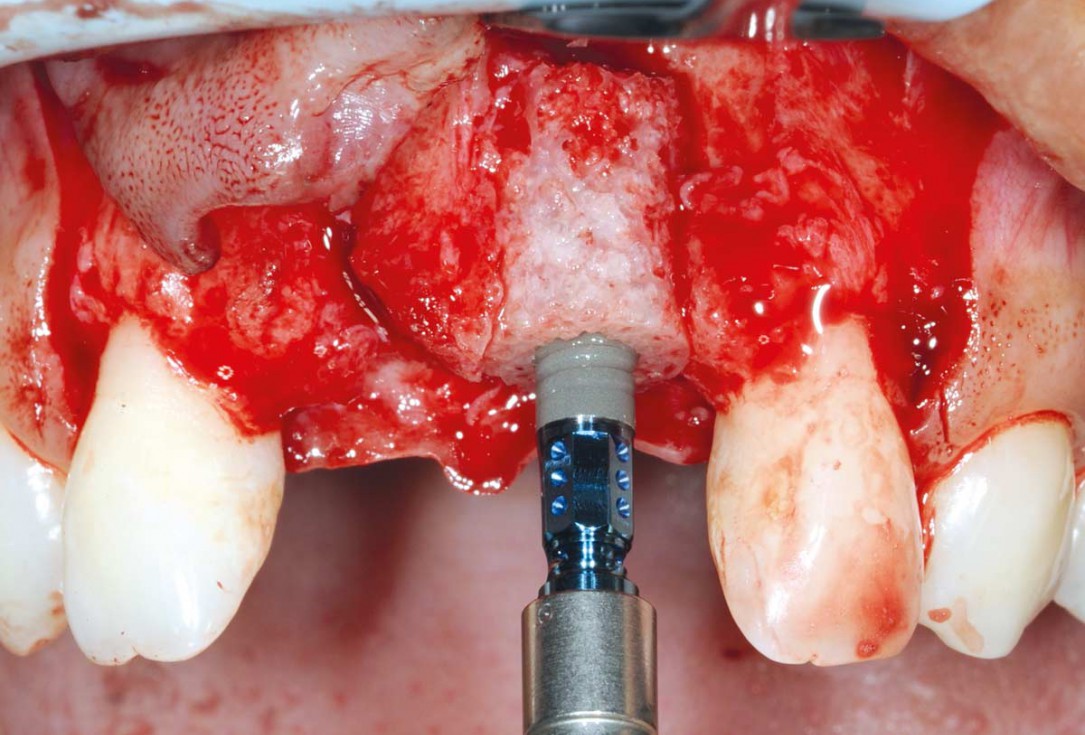 Bone augmentation in aesthetic zone with maxgraft® bonering - Dr. A. Patel