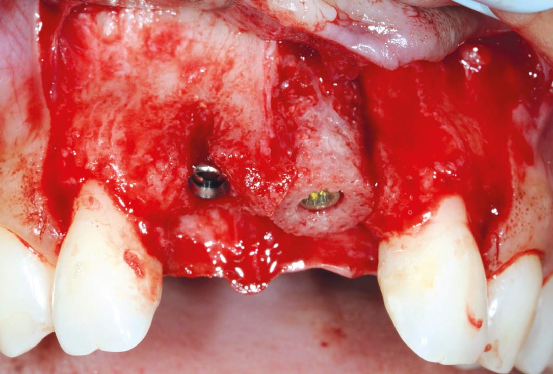 Bone augmentation in aesthetic zone with maxgraft® bonering - Dr. A. Patel