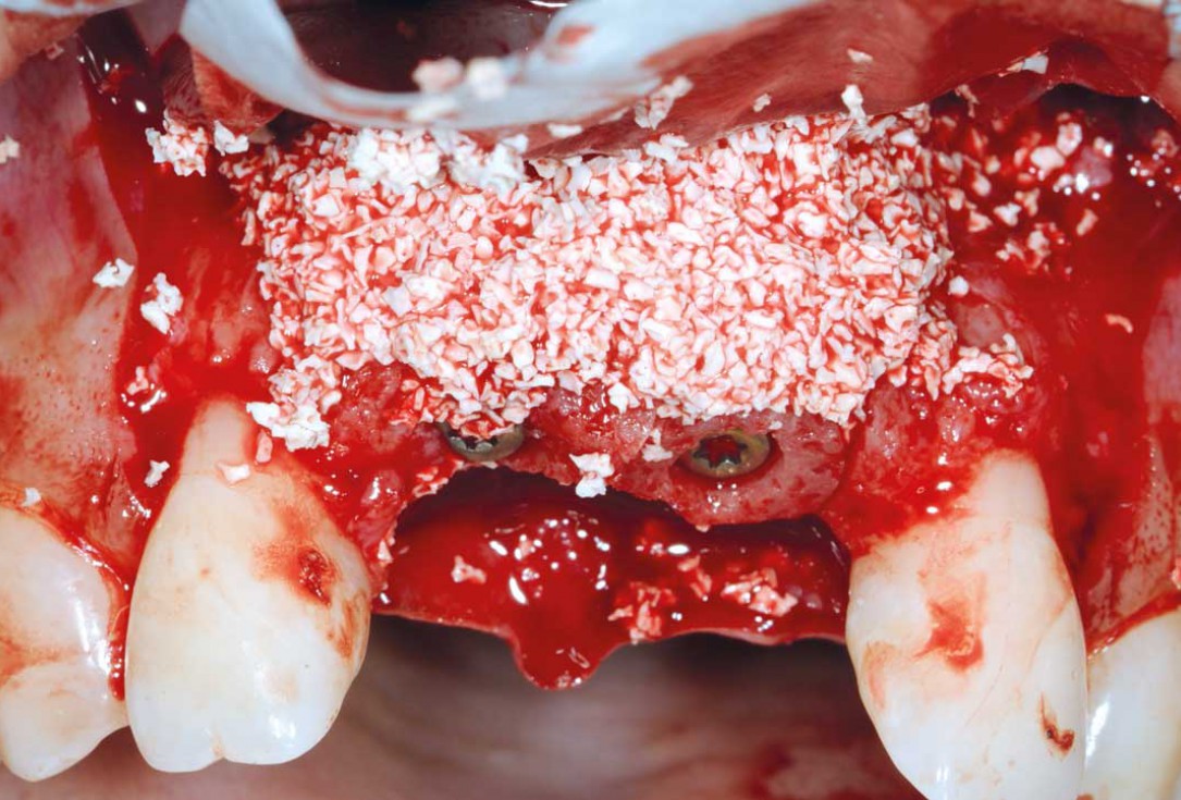 Bone augmentation in aesthetic zone with maxgraft® bonering - Dr. A. Patel