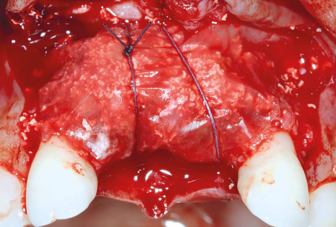 Bone augmentation in aesthetic zone with maxgraft® bonering - Dr. A. Patel