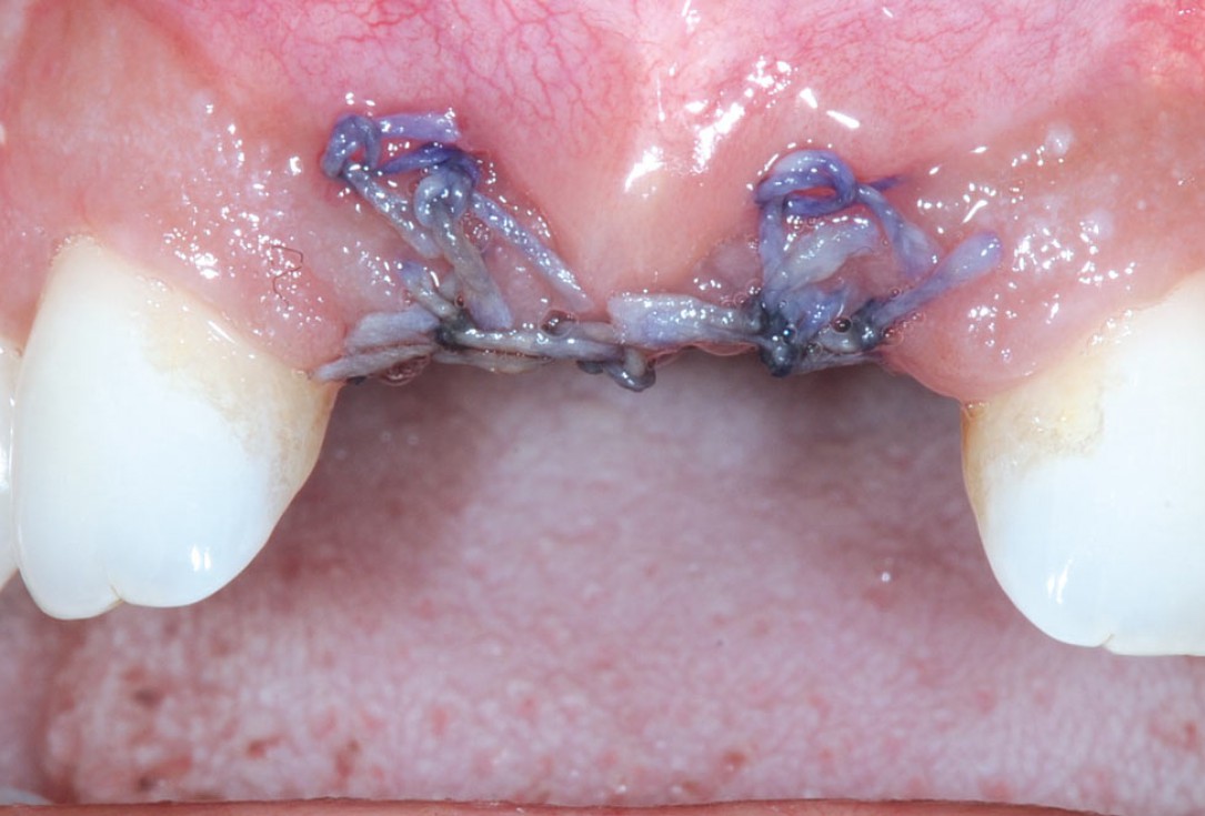 Bone augmentation in aesthetic zone with maxgraft® bonering - Dr. A. Patel