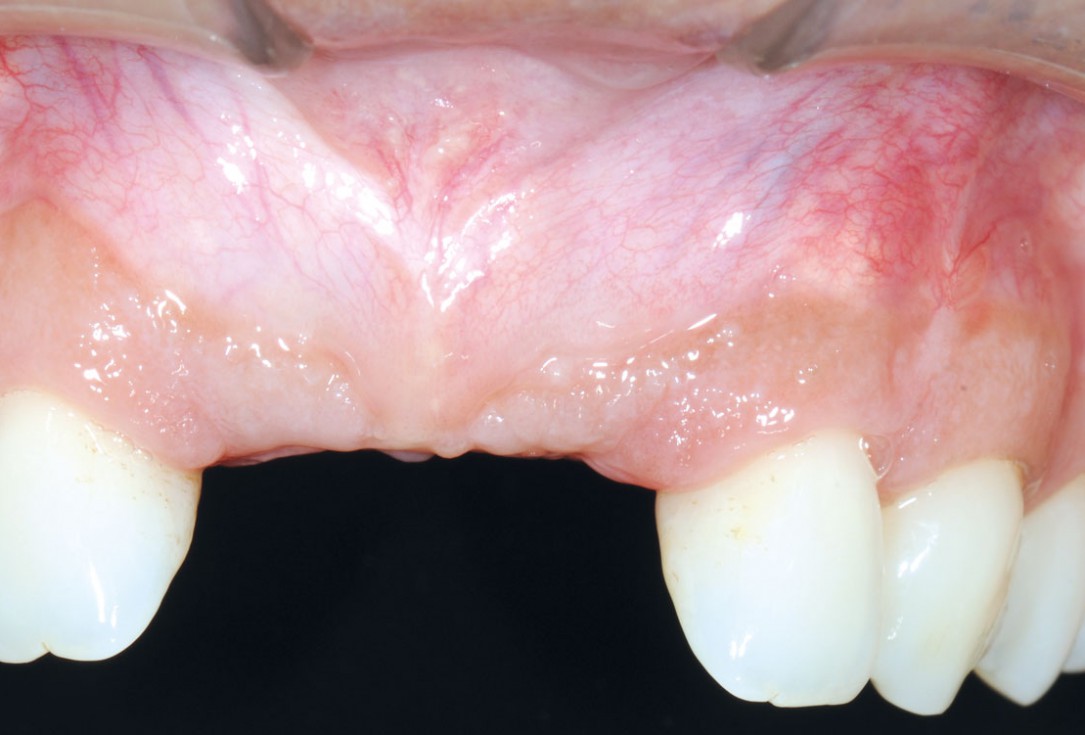 Bone augmentation in aesthetic zone with maxgraft® bonering - Dr. A. Patel