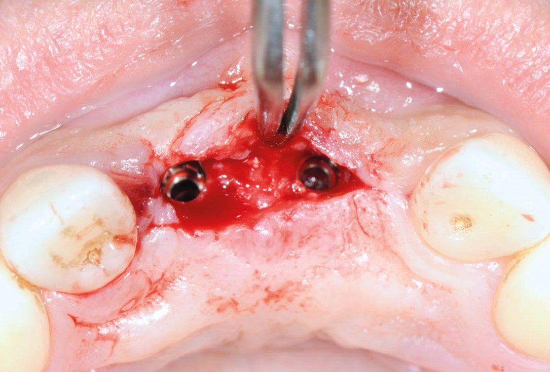 Bone augmentation in aesthetic zone with maxgraft® bonering - Dr. A. Patel