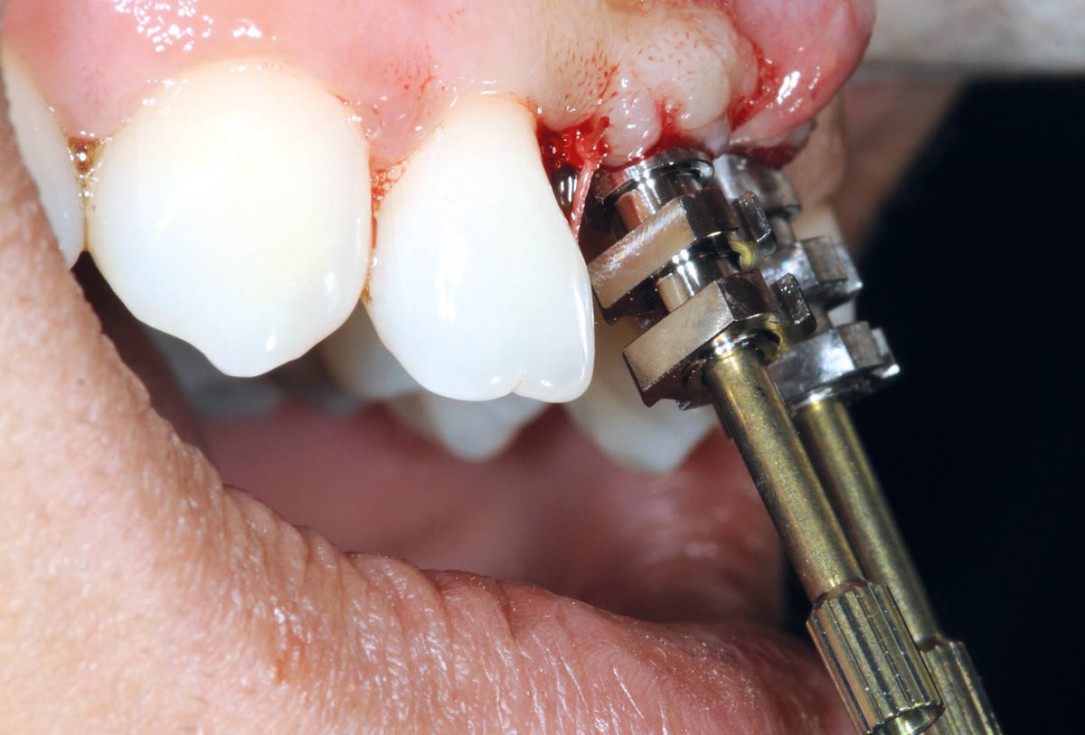 Bone augmentation in aesthetic zone with maxgraft® bonering - Dr. A. Patel