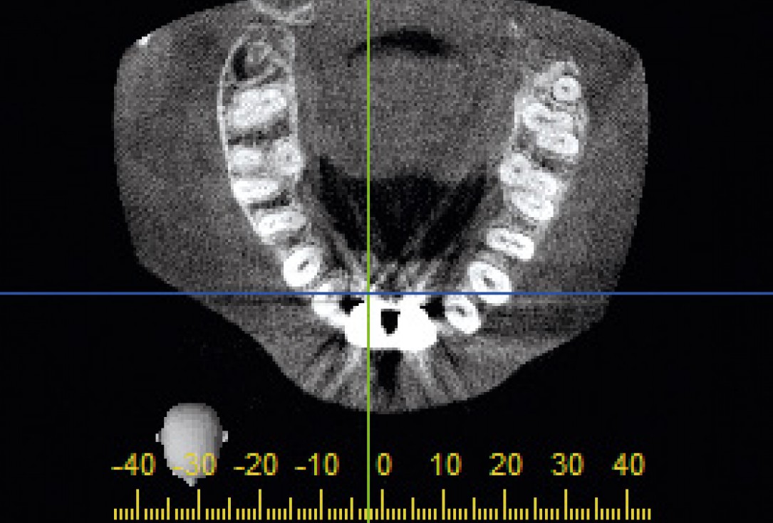 Bone augmentation in aesthetic zone with maxgraft® bonering - Dr. A. Patel
