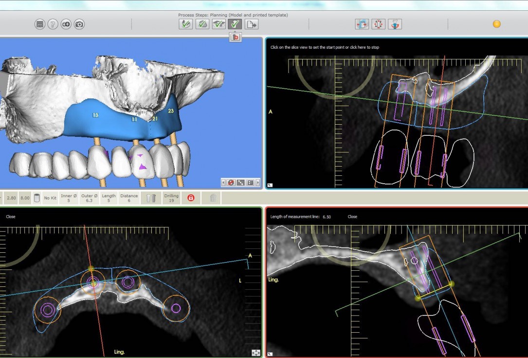 botiss maxgraft® bonebuilder for maxilla reconstruction - Clinical case