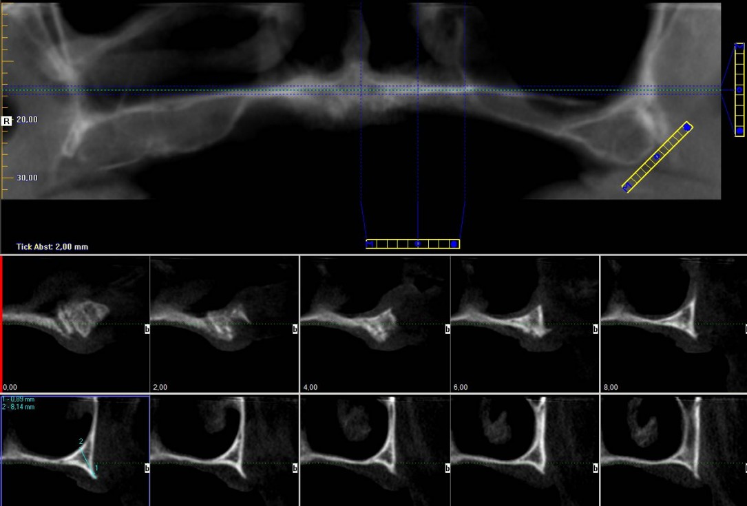 botiss maxgraft® bonebuilder for maxilla reconstruction - Clinical case