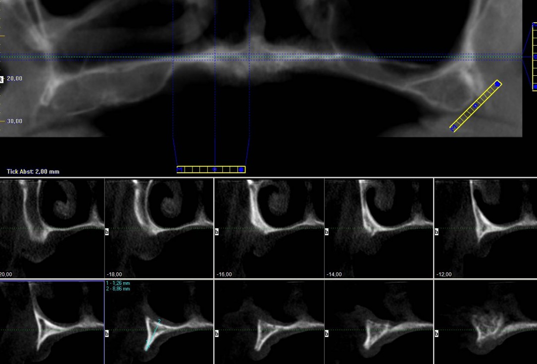 botiss maxgraft® bonebuilder for maxilla reconstruction - Clinical case
