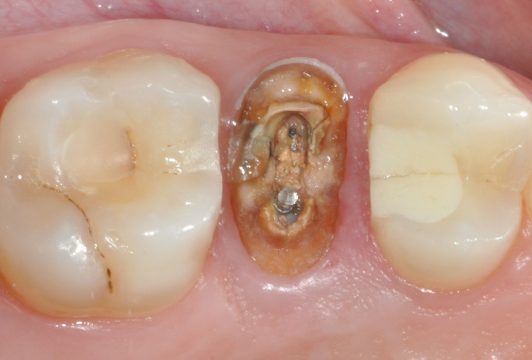 Application of collacone® to extraction socket