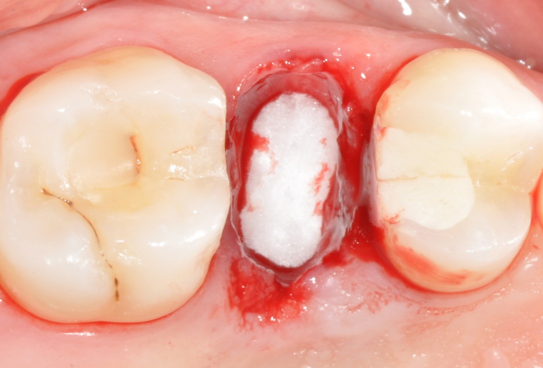 Application of collacone® to extraction socket