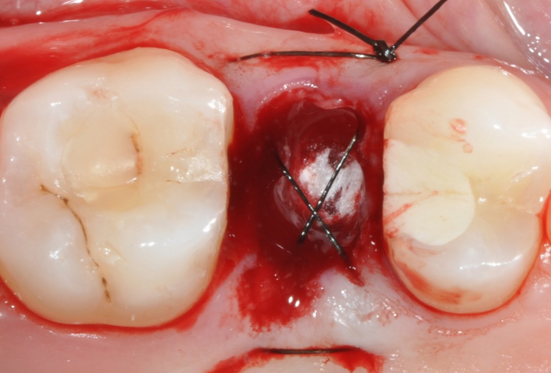 Application of collacone® to extraction socket